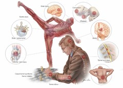 BRAIN INJURY CONCUSSION SPORTS INJURY WHIPLASH  BRAIN / SPINE TUMOR STROKE ARTHRITIS / JOINT INJURY SPINAL CORD INJURY CARPAL TUNNEL SYNDROME NERVE IRRITATION TENNIS ELBOW BONA KIRN BACK PAIN