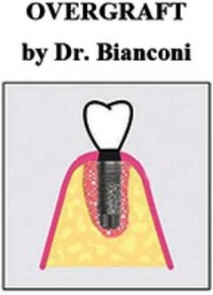 OVERGRAFT by Dr. Bianconi