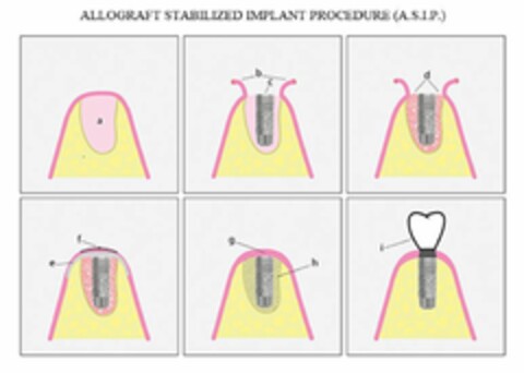 ALLOGRAFT STABILIZED IMPLANT PROCEDURE (A.S.I.P.) Logo (EUIPO, 04/27/2016)